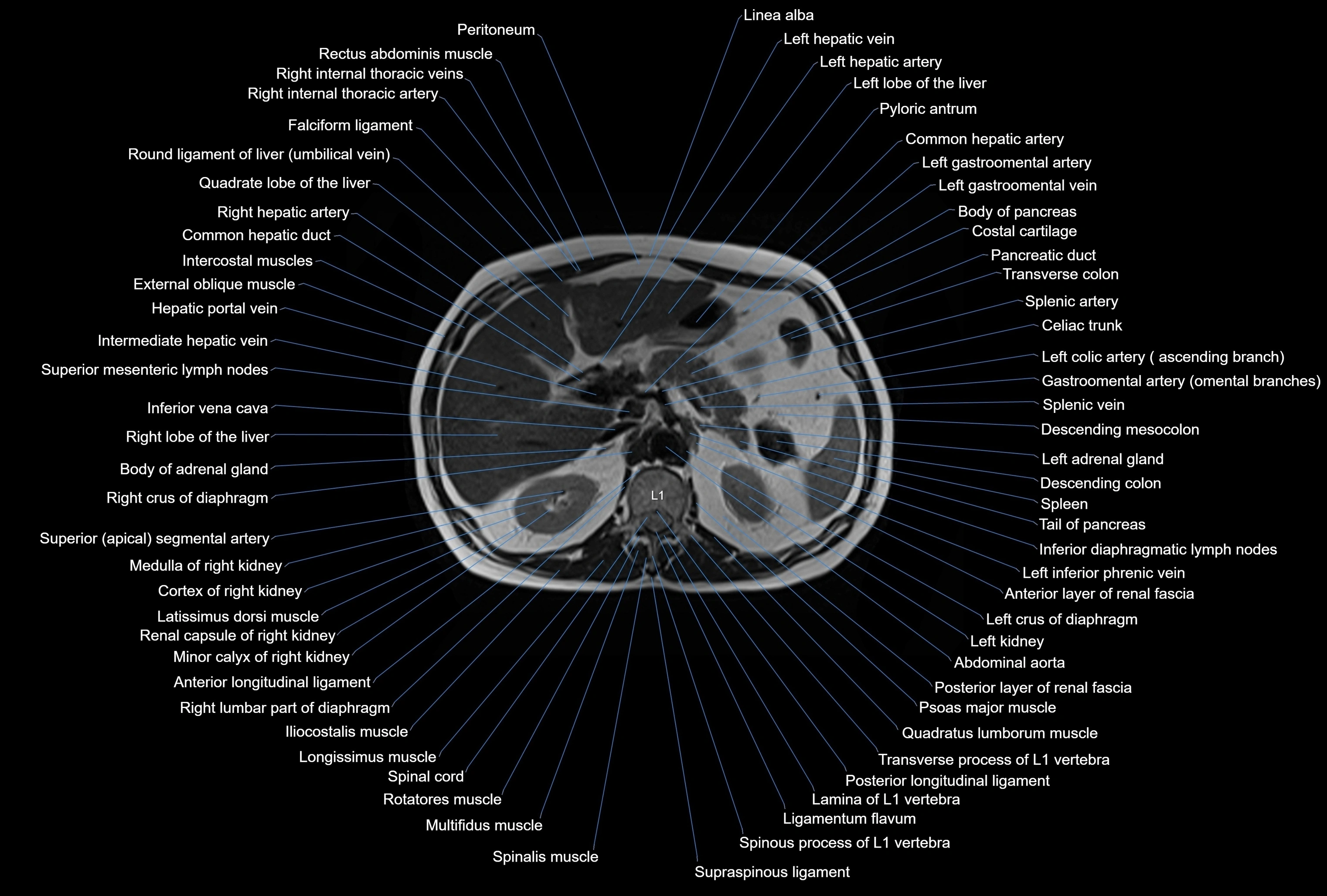 MRI Abdomen axial cross sectional anatomy radiology  image-img-00001-00016.webp